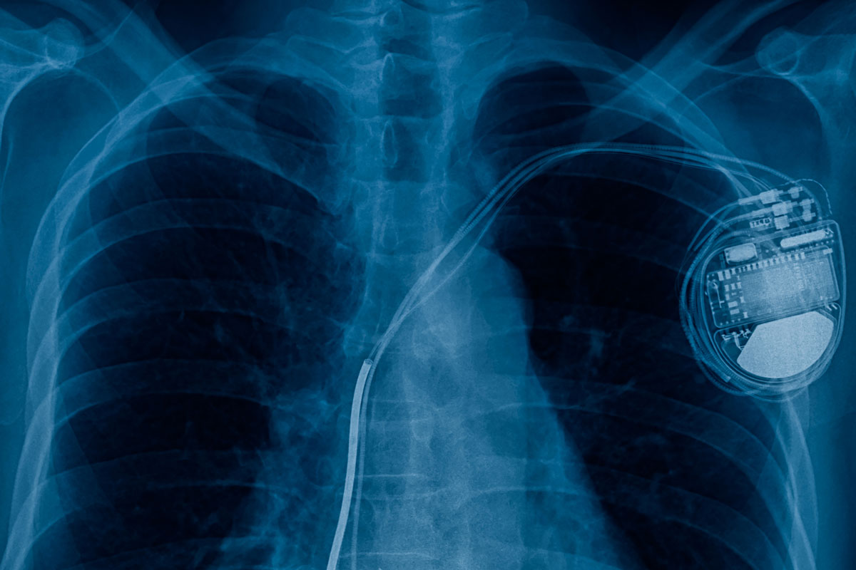 Nutzen von implantierten Defibrillatoren