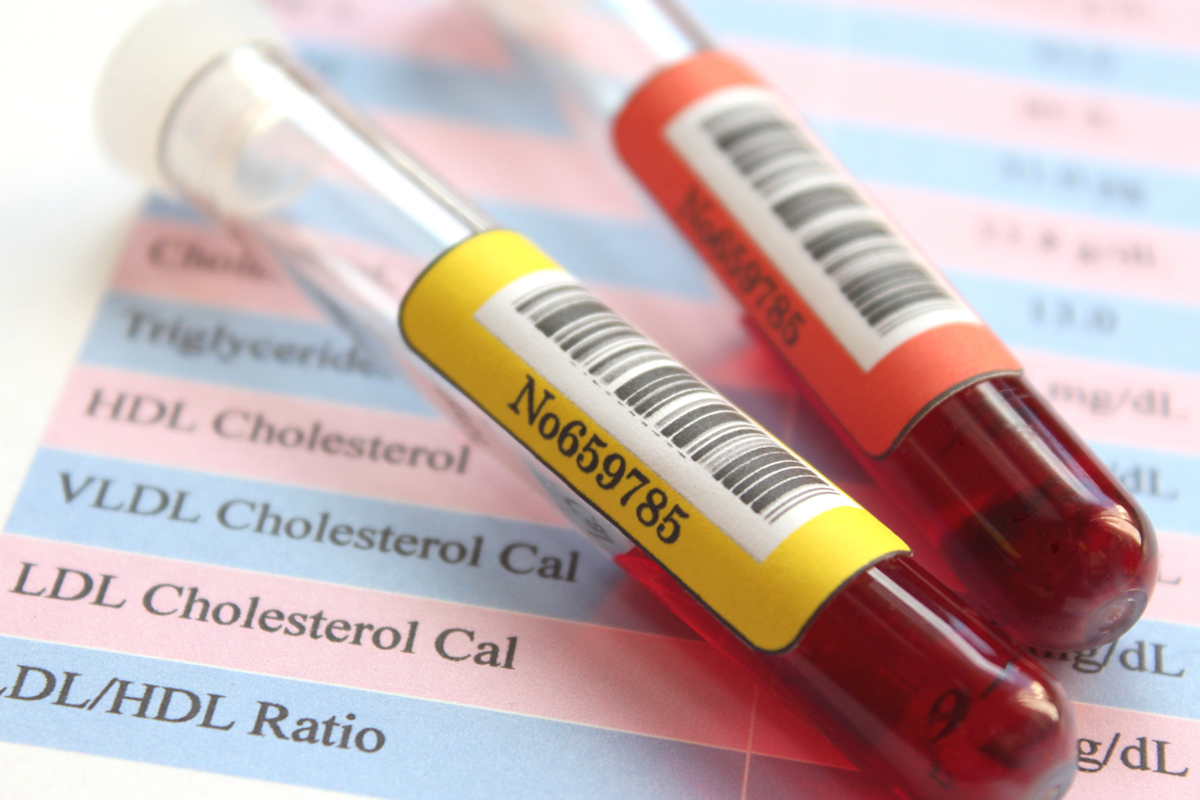 Gefährdung durch hohe HDL-Cholesterinwerte