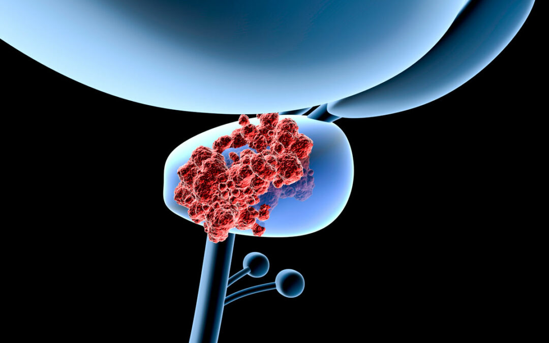 Medikament erhöht Aufnahme von Radioaktivität in Tumorzellen