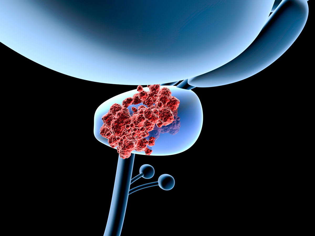 Metastasenbildung von Prostatakrebs untersucht