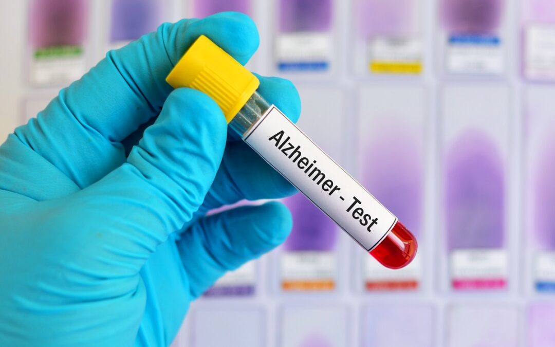 Bluttest zur Ermittlung des Alzheimer-Risikos