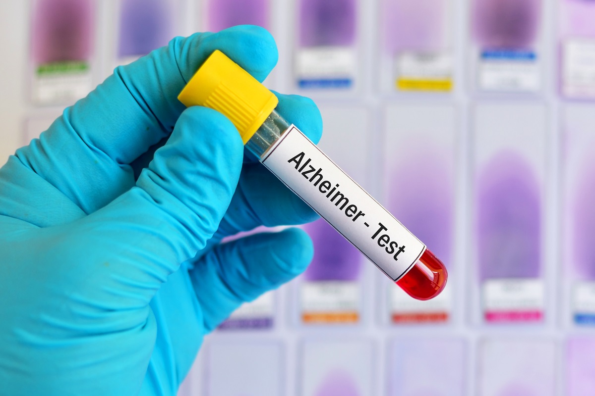 Bluttest zur Ermittlung des Alzheimer-Risikos
