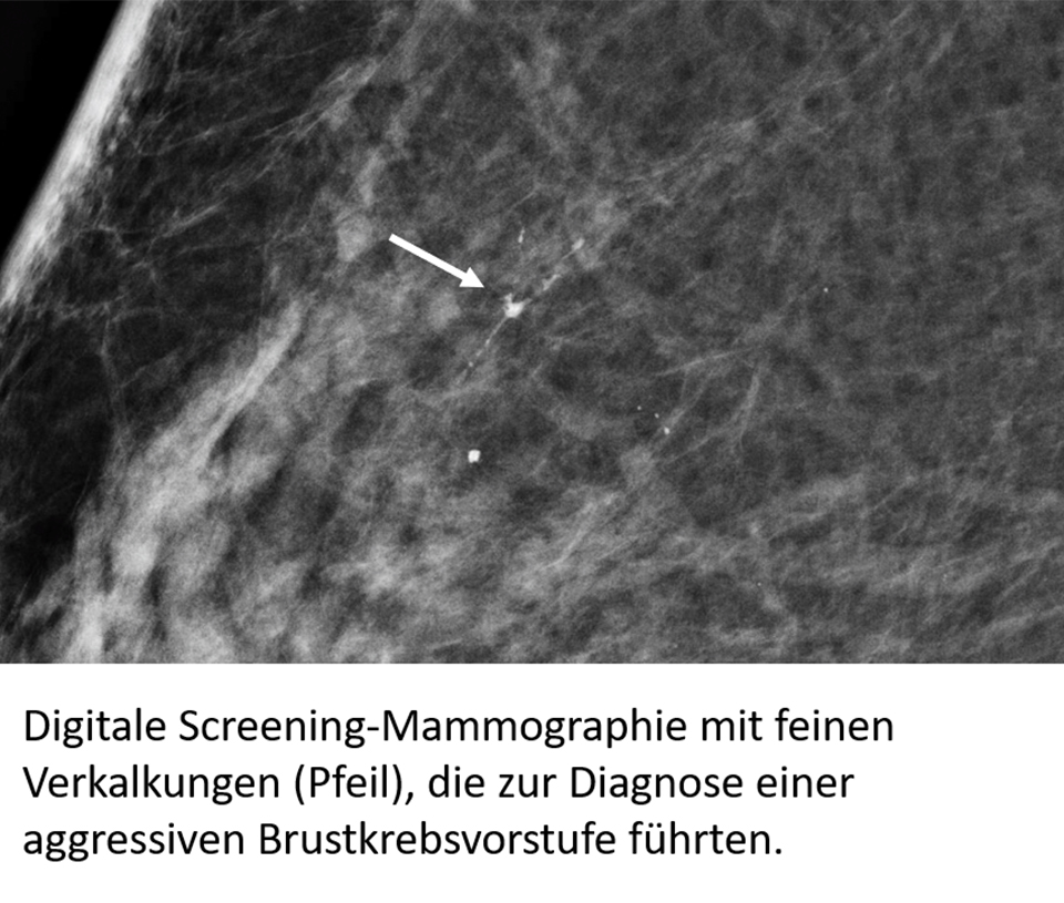 Mammographie-Befund © Universitätsklinikum Münster
