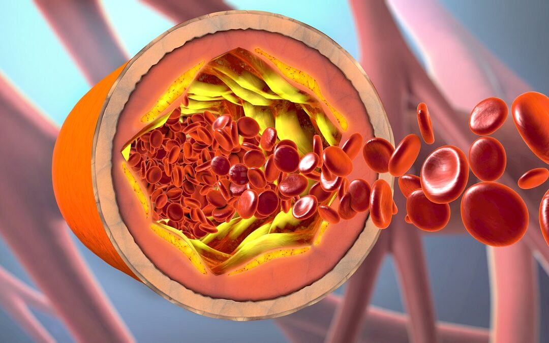 Wie Signalproteine in Immunzellen die Atherosklerose beeinflussen