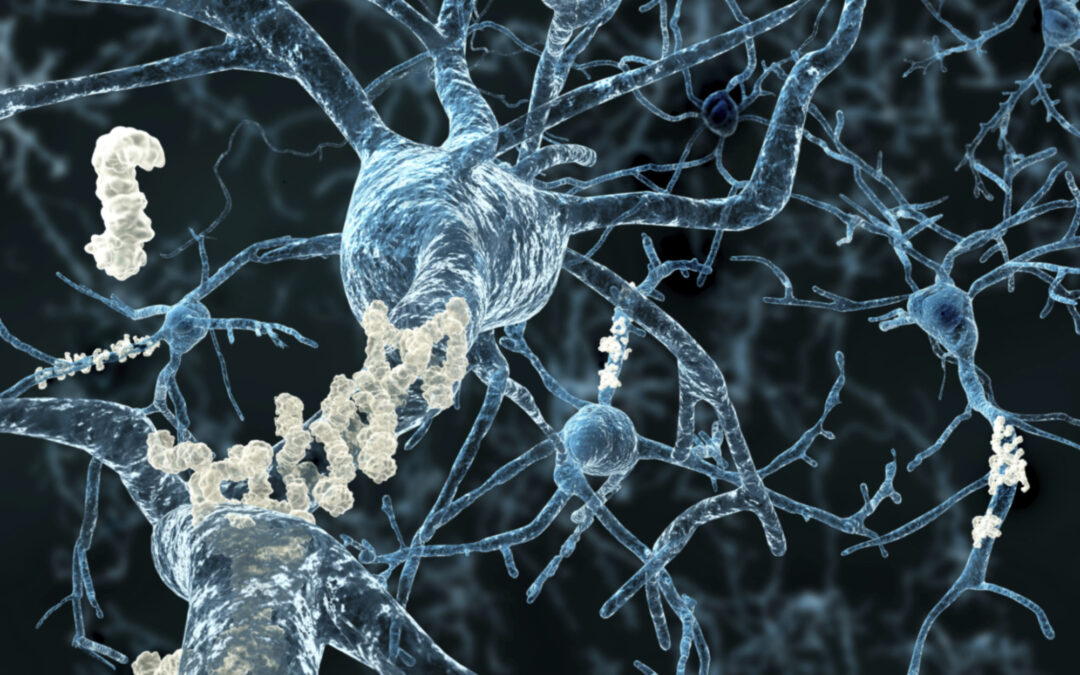 Immunzellen bleiben inaktiv gegen Alzheimer-Plaques