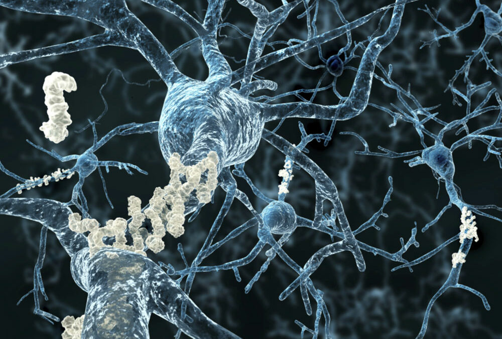 Krankheitsverlauf von Alzheimer untersucht