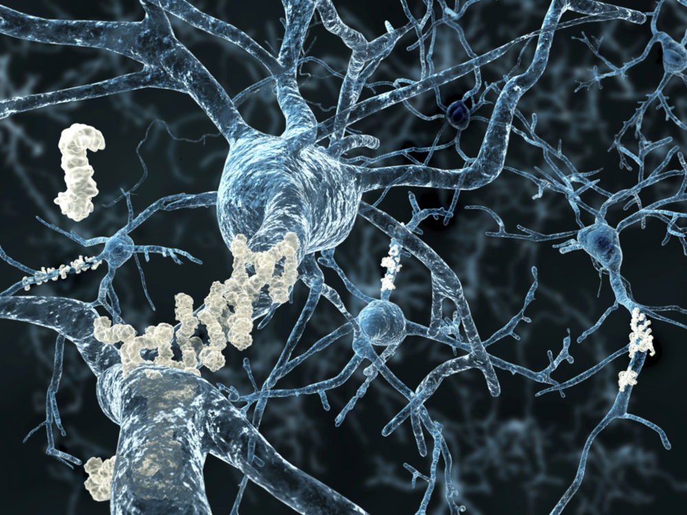 Krankheitsverlauf von Alzheimer untersucht