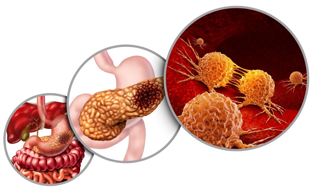CAR-T-Zellen zur Bekämpfung von Bauchspeicheldrüsenkrebs