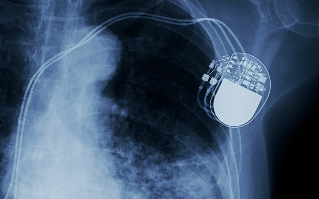 Herzeingriffe mit geringerer Röntgenbelastung
