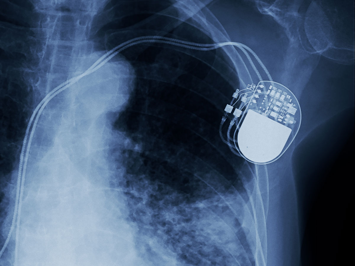 Herzeingriffe mit geringerer Röntgenbelastung