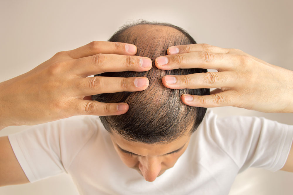 Genetische Faktoren von Haarausfall untersucht