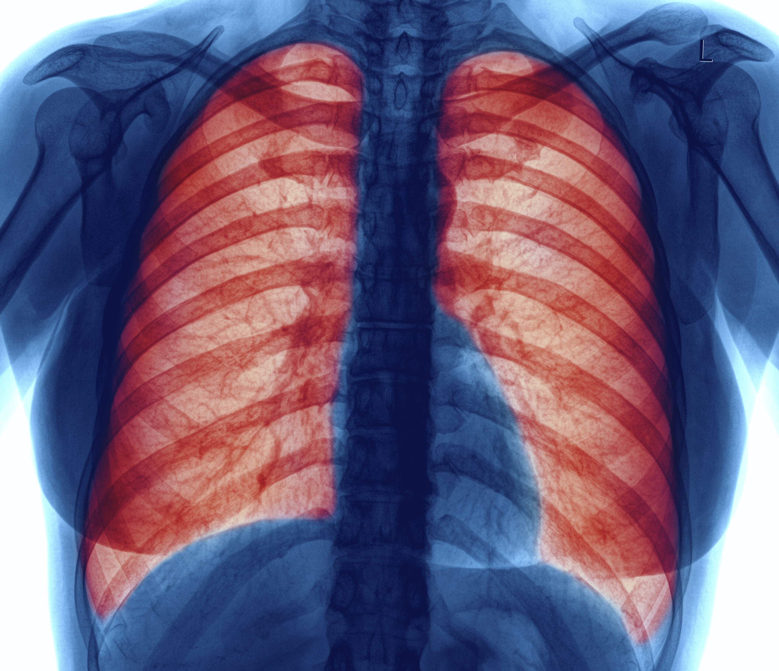 Ältere Lungen stärker betroffen