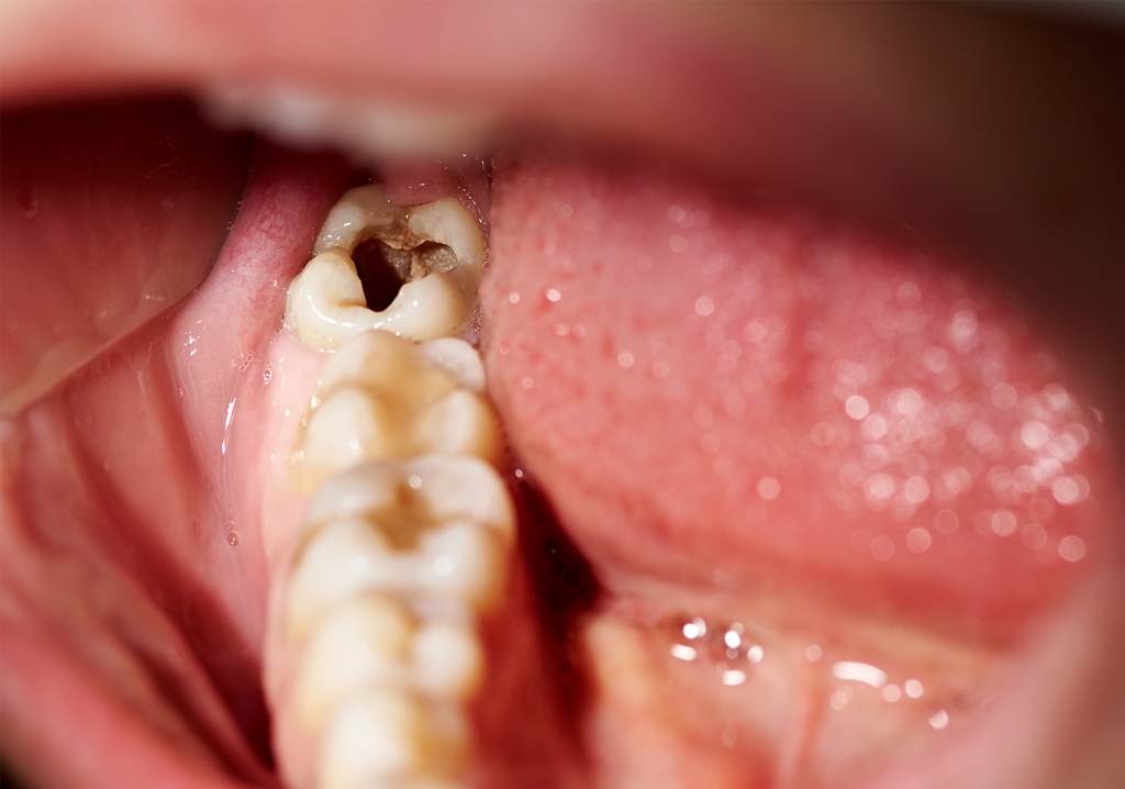 Kalziumtoleranz lässt Bakterien im Zahnbelag überleben