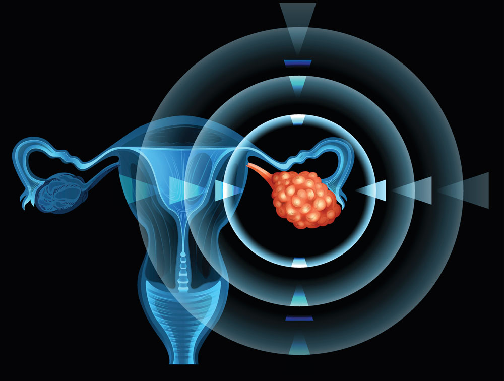 Signalmolekül beeinflusst Verlauf von Eierstockkrebs