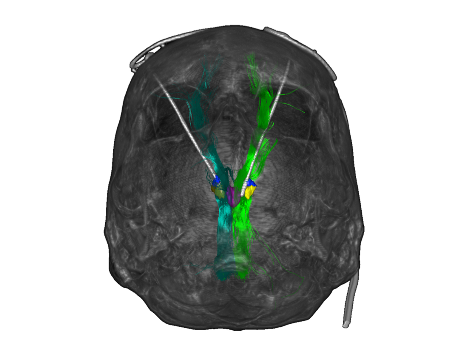 Abbildung Gehirn © Universitätsklinikum Freiburg