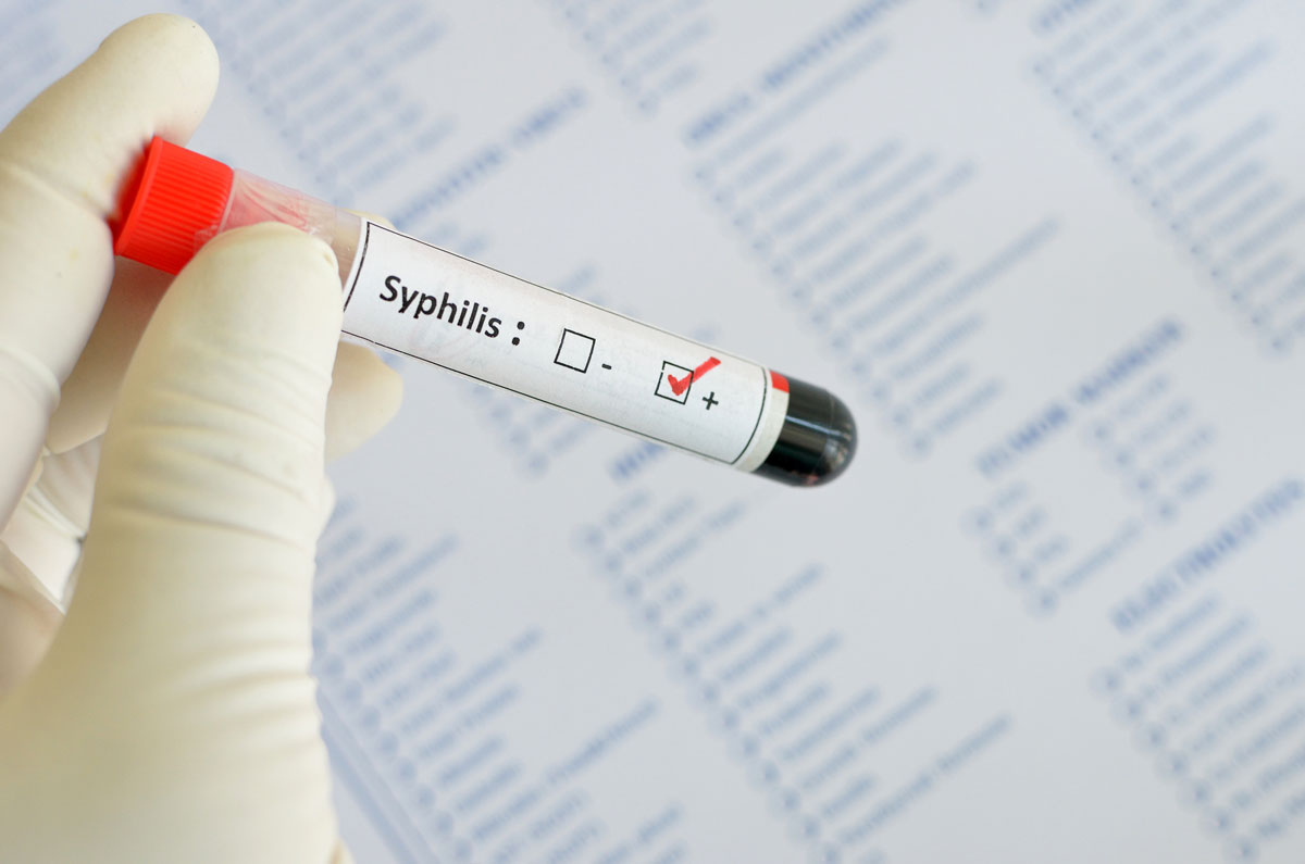 Jahrtausendealte Syphilis-Genome geborgen