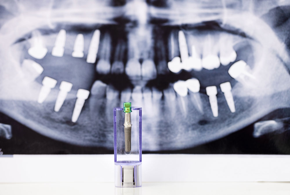 Einheilen von Zahnimplantaten verbessern
