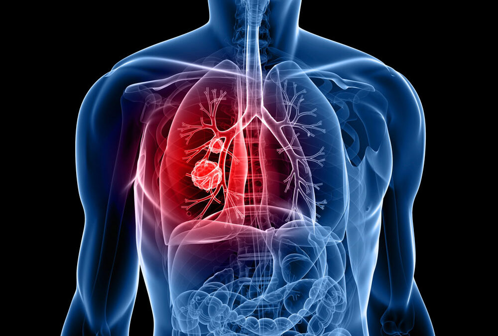 Den Krebs in der Lunge besiegen