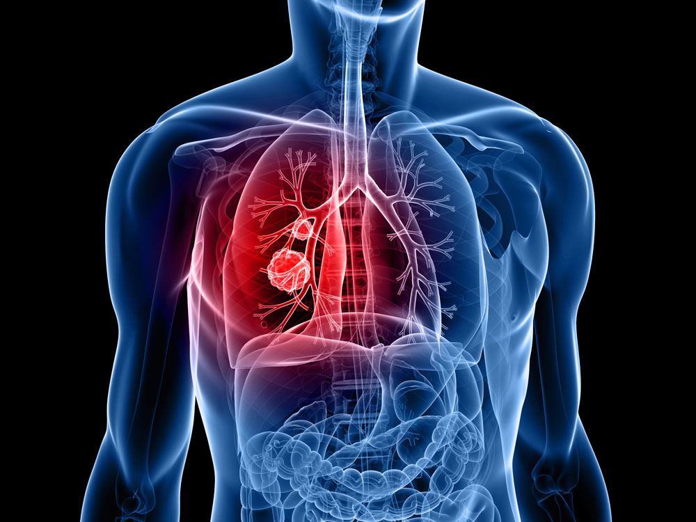 Den Krebs in der Lunge besiegen
