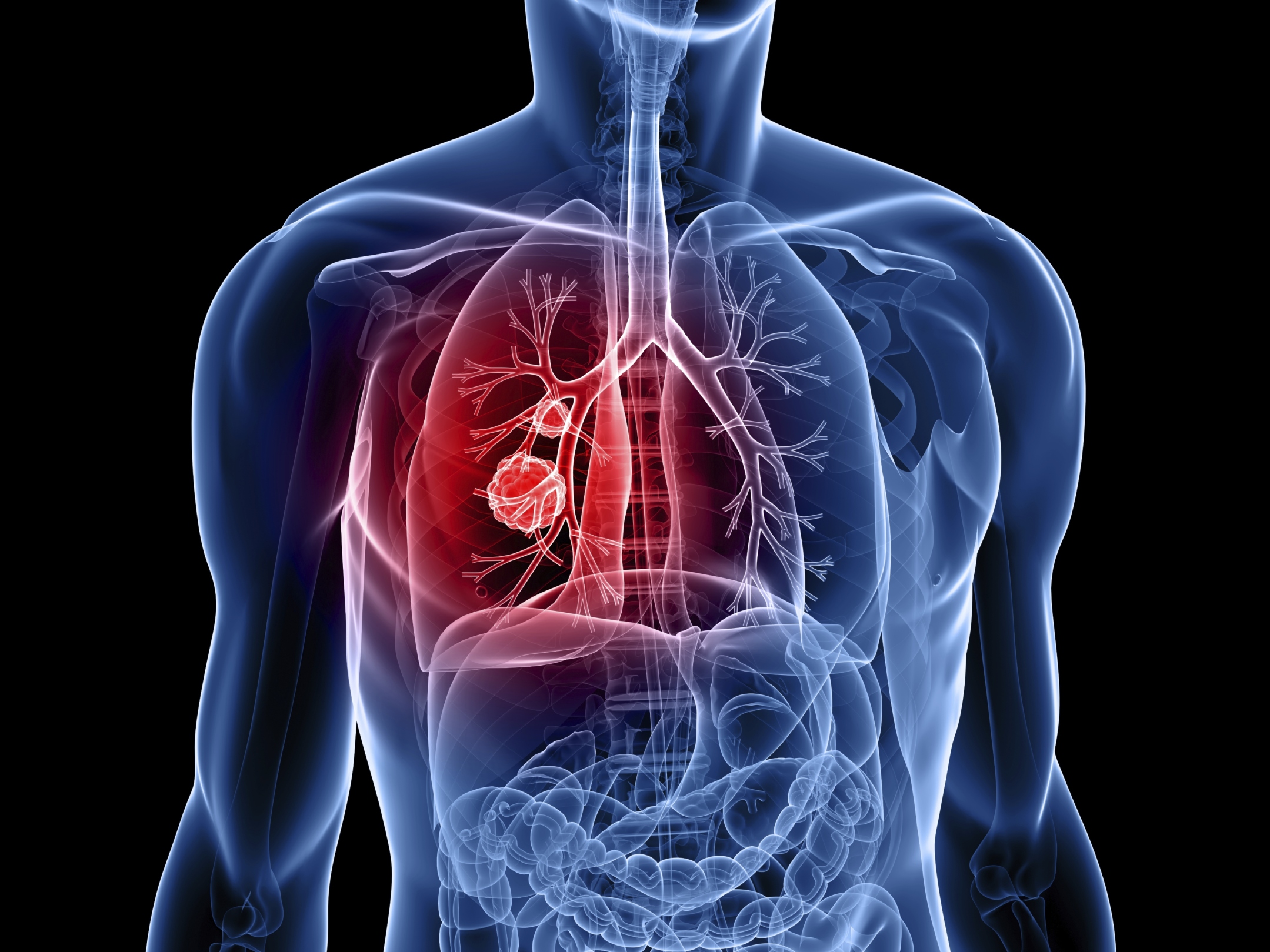 Was geben die Kassen für Lungenkrebs aus?
