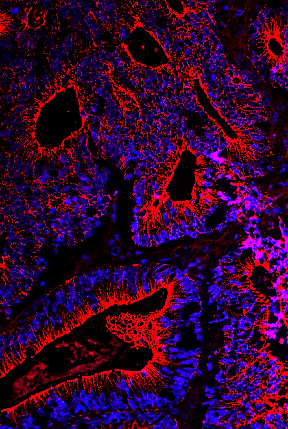 Darmkrebs unter dem Mikroskop © Lutz Langbein / DKFZ