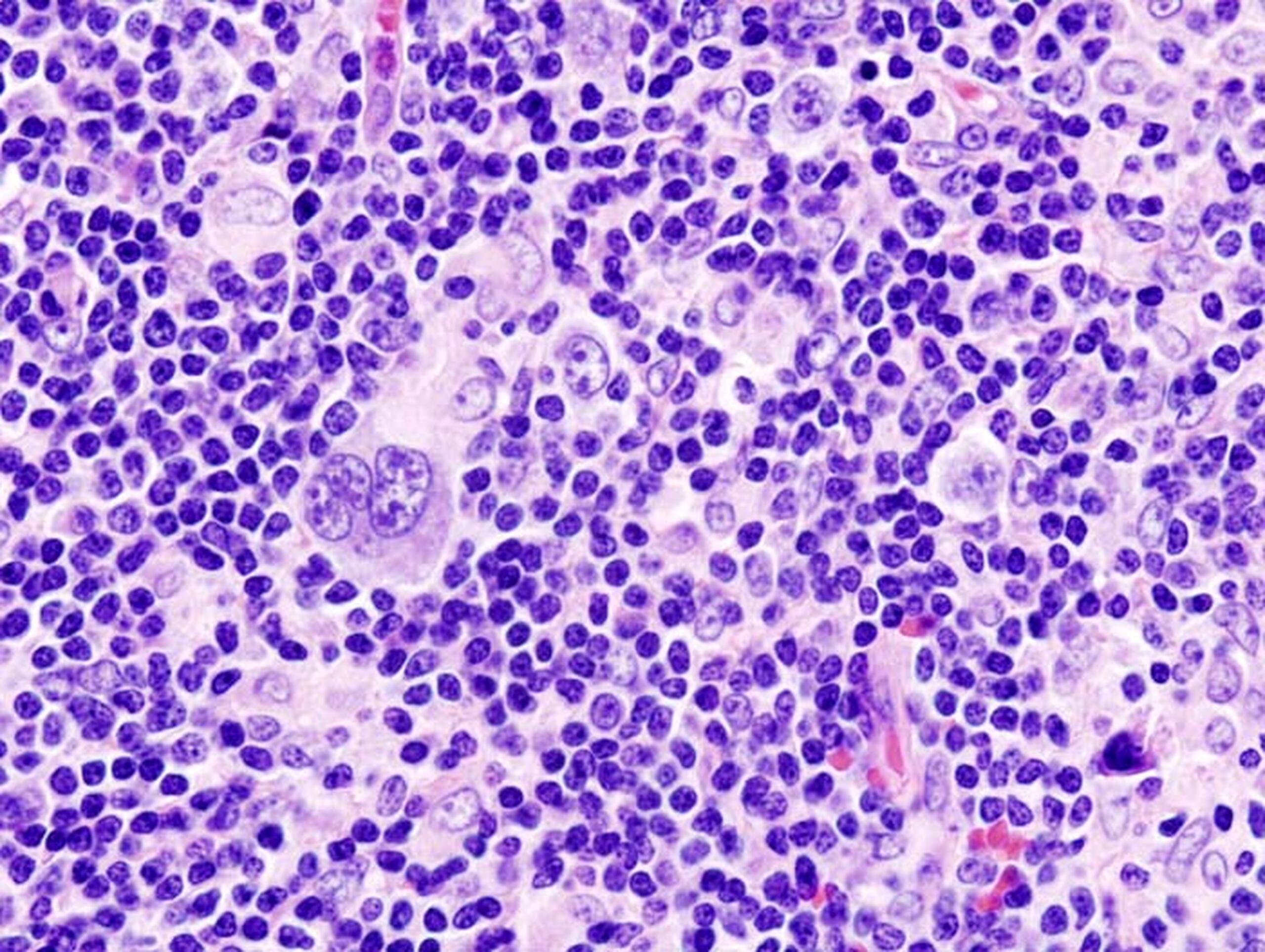 Histopathologisches Bild eines Hodgkin-Lymphoms. Probe aus einer Lymphknotenbiospie, Hämatoxylin/Eosin-Färbung. © KGH , CC BY-SA 3.0 DE