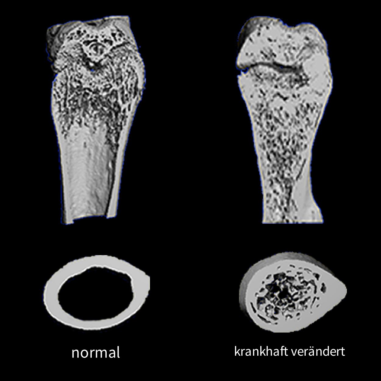 Normale Knochen und krankhaft veränderter Knochen Abb. © Gruppe Waskow / FLI