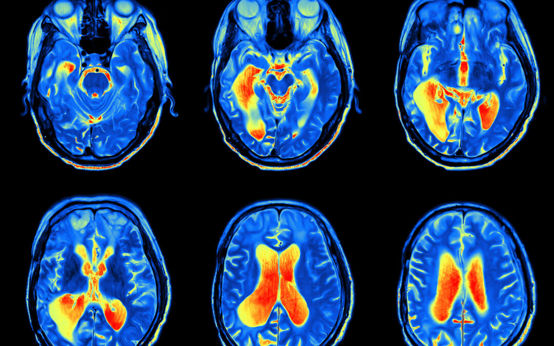 Hochauflösendes MRT zeigt bislang verborgene Gehirnregion