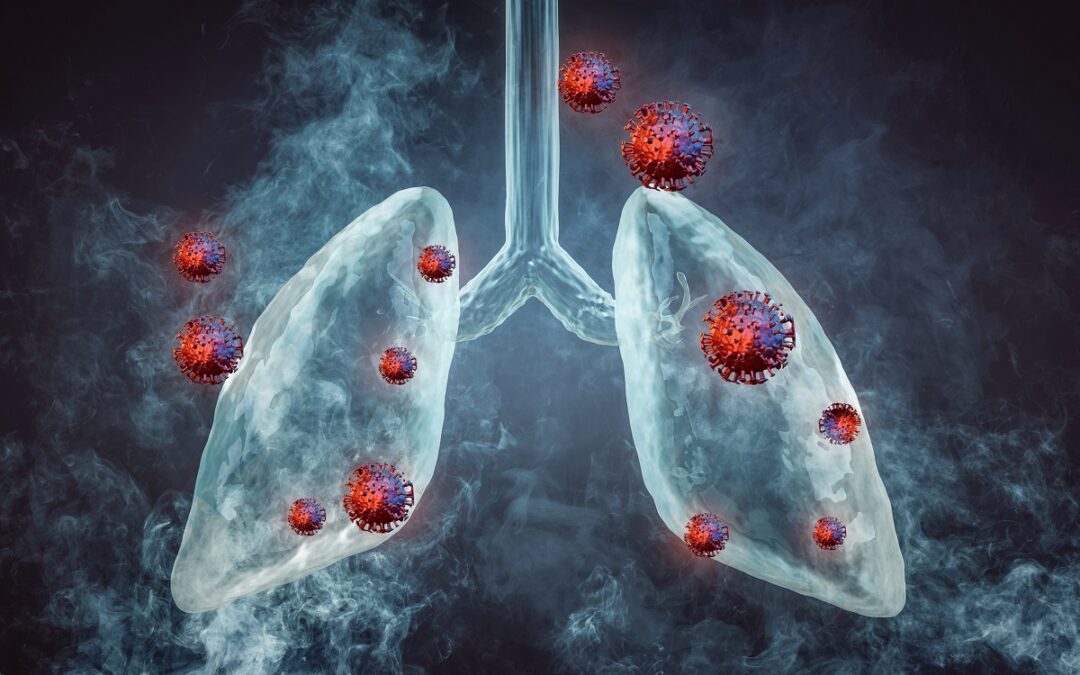 Forschende analysieren Vorgehen der Coronaviren in menschlichen Lungen