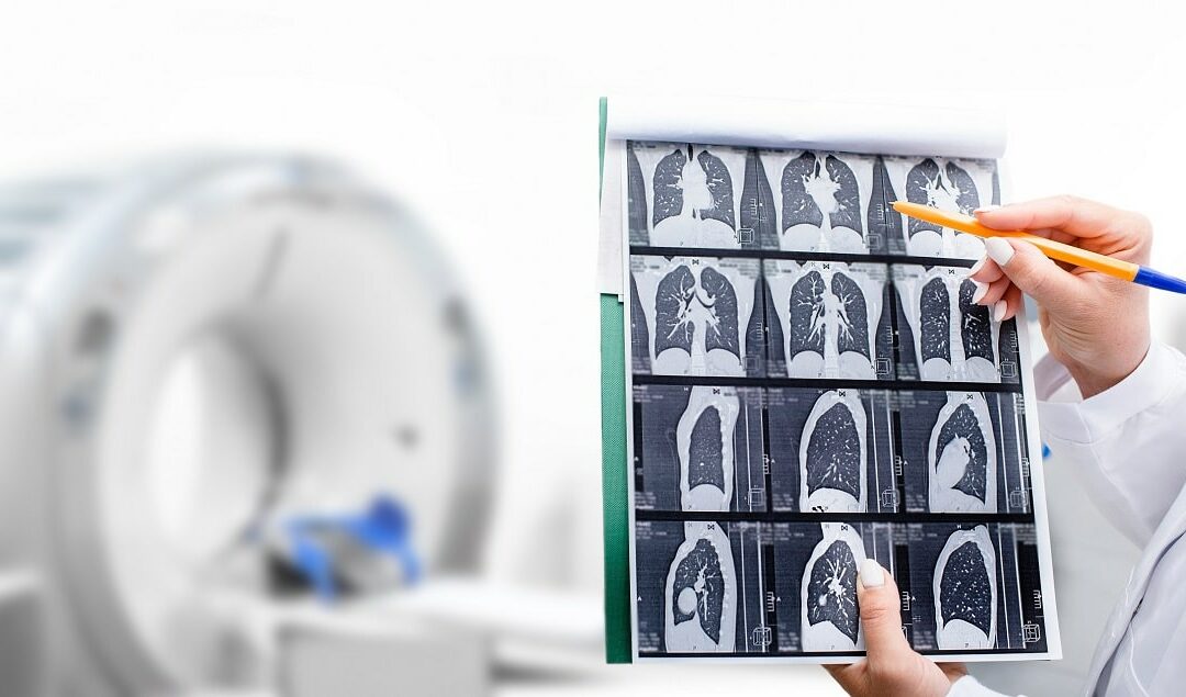 Experten-Bericht unterstreicht Potenzial von Niedrigdosis-CT in der Früherkennung