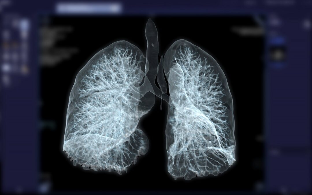 Lungenkrebsfrüherkennung durch Niedrigdosis-CT