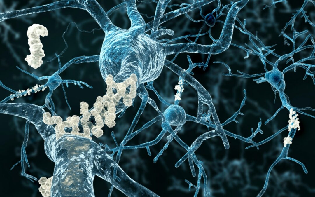 Neue Erkenntnisse zur neurodegenerativen Erkrankung