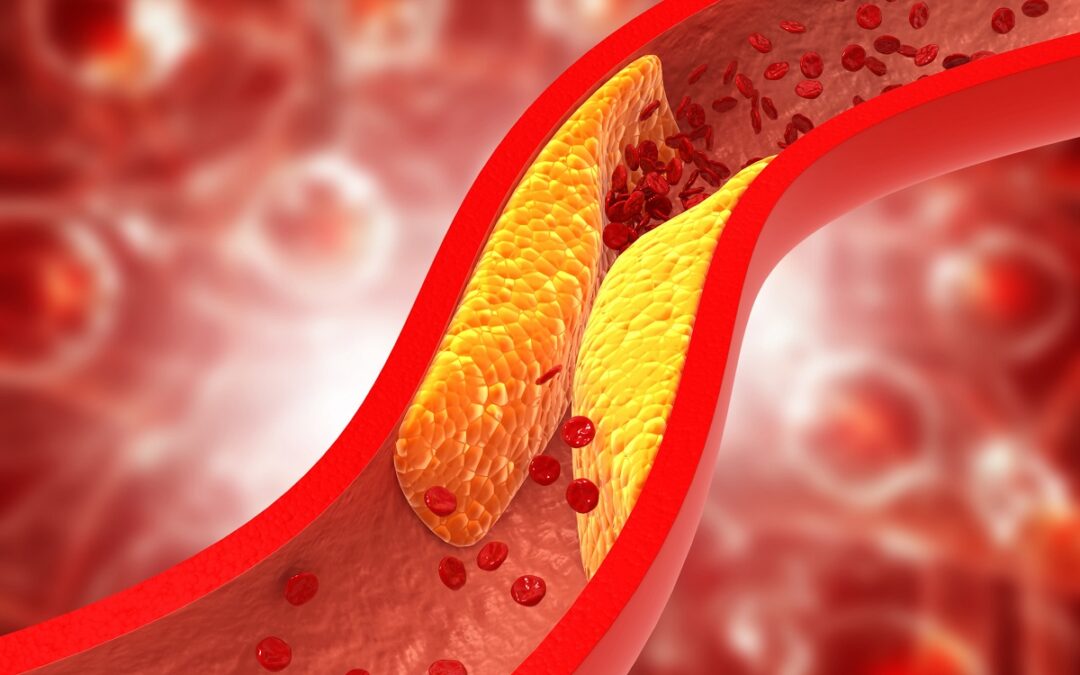 Auswirkungen erhöhter Blutfettwerte bei Stoffwechselerkrankungen