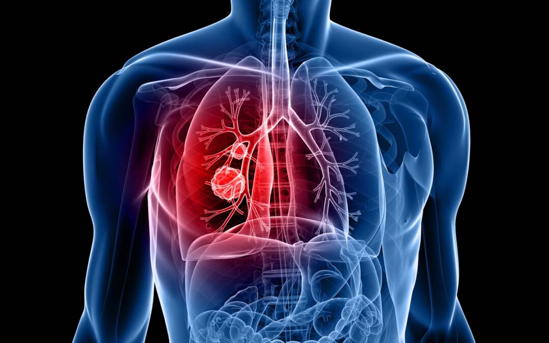 Maßgeschneiderte Therapien für seltene Lungenkrebs-Mutation