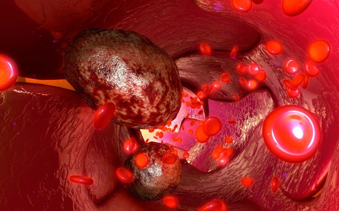 Krebszellen verstecken sich in Knochenmarksnischen