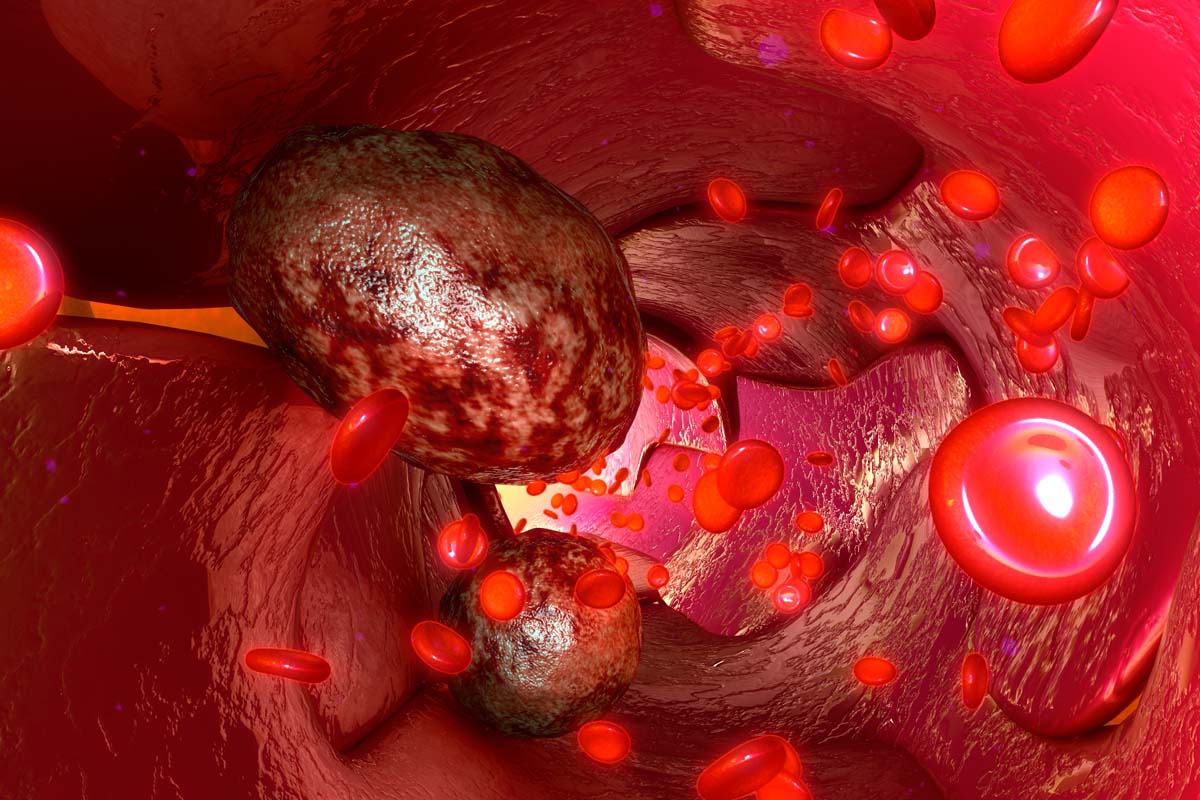 Krebs- und Blutzellen in Blutgefäß.