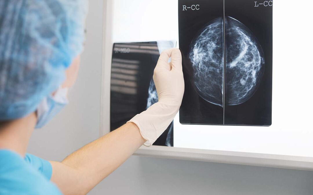 Nutzenbewertung des Mammografie-Screenings für verschiedene Frauengruppen