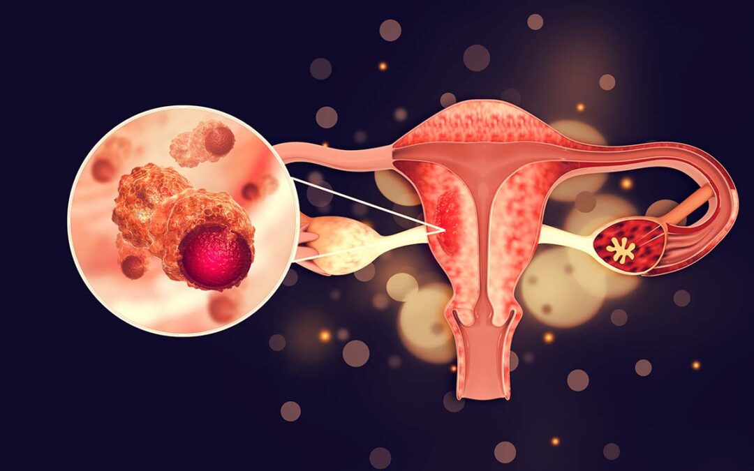 Entstehung von Eierstockkrebs untersucht