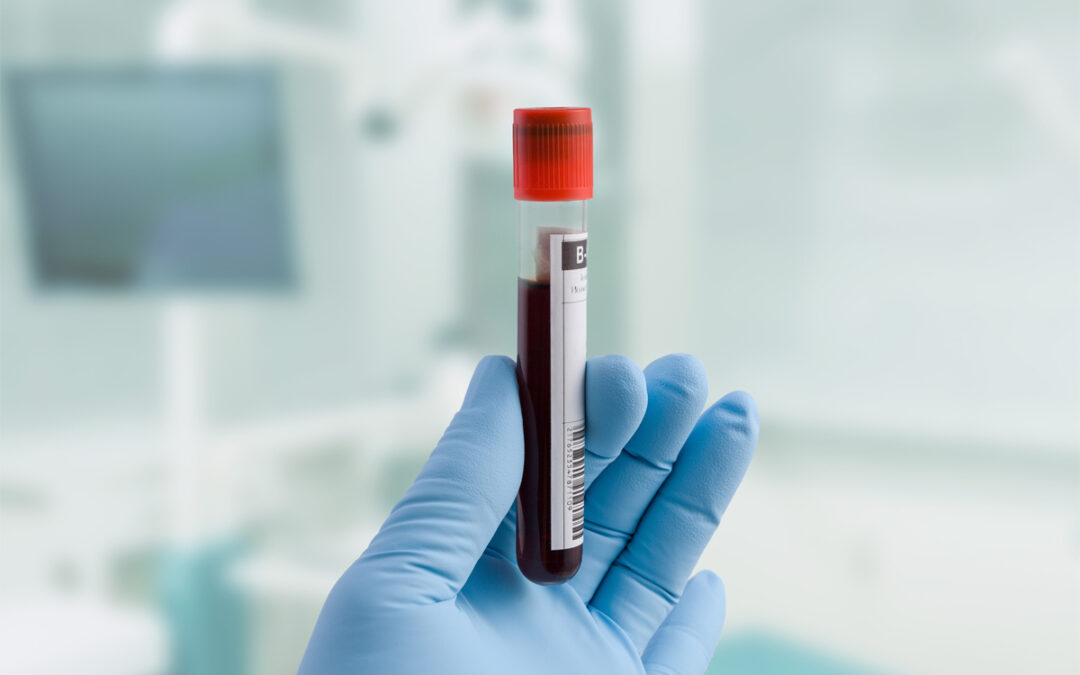 PFAS im Blut als Ursache für ungünstige Blutfette identifiziert