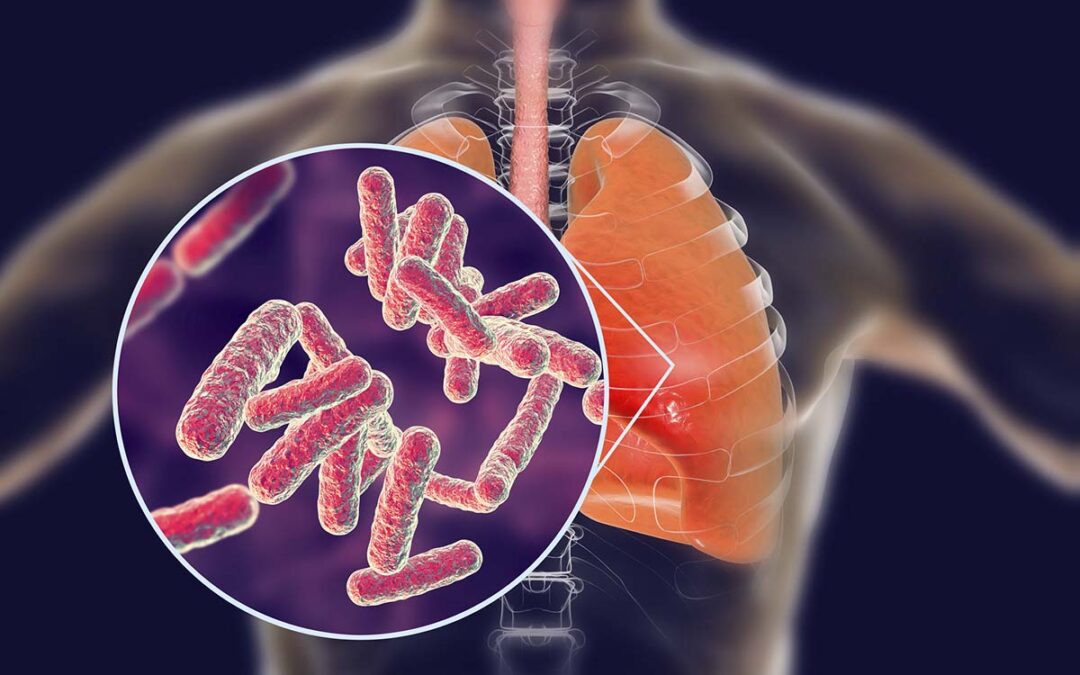 Ein vielversprechender Weg zur Bekämpfung von Tuberkulose