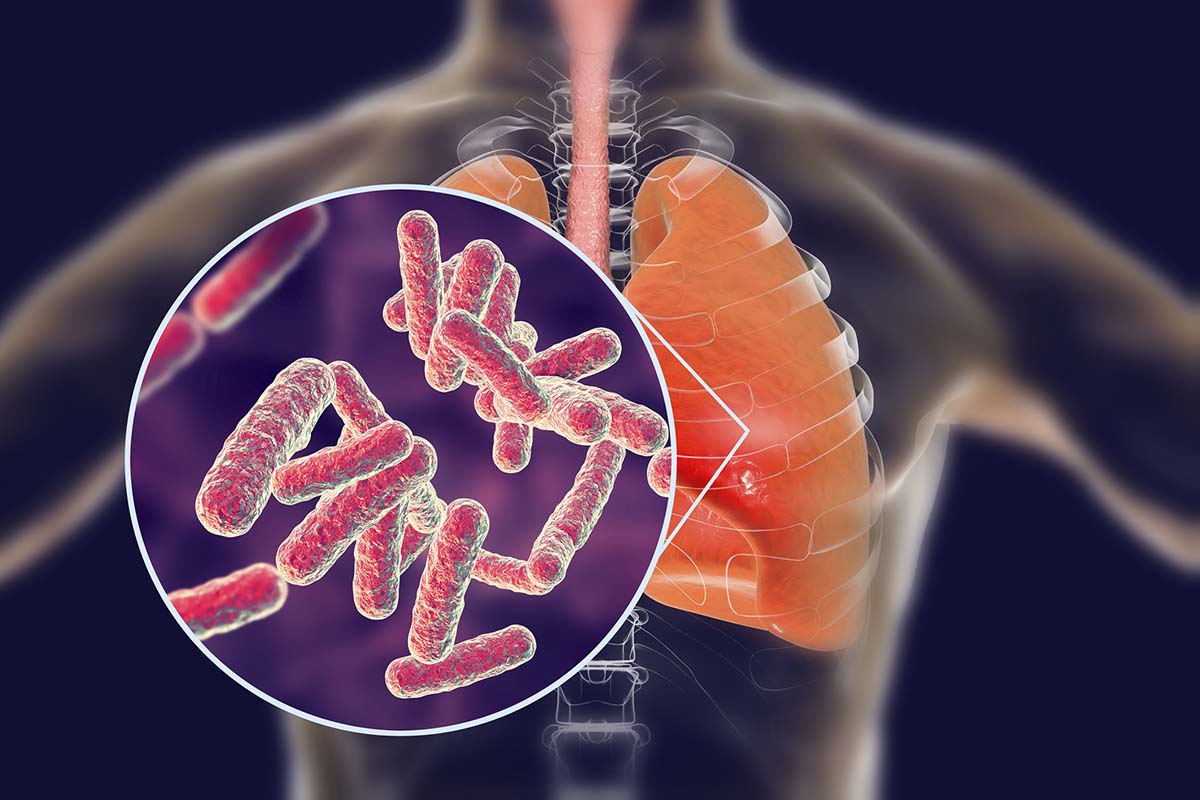 Abbildung einer Lunge und Nahaufnahme von Tuberkulose-Bakterien.