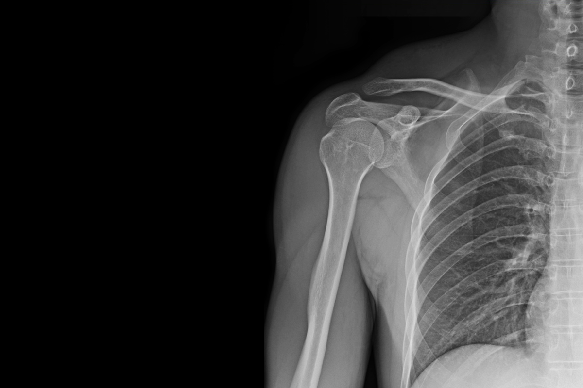 Röntgenbild des Schultergelenks