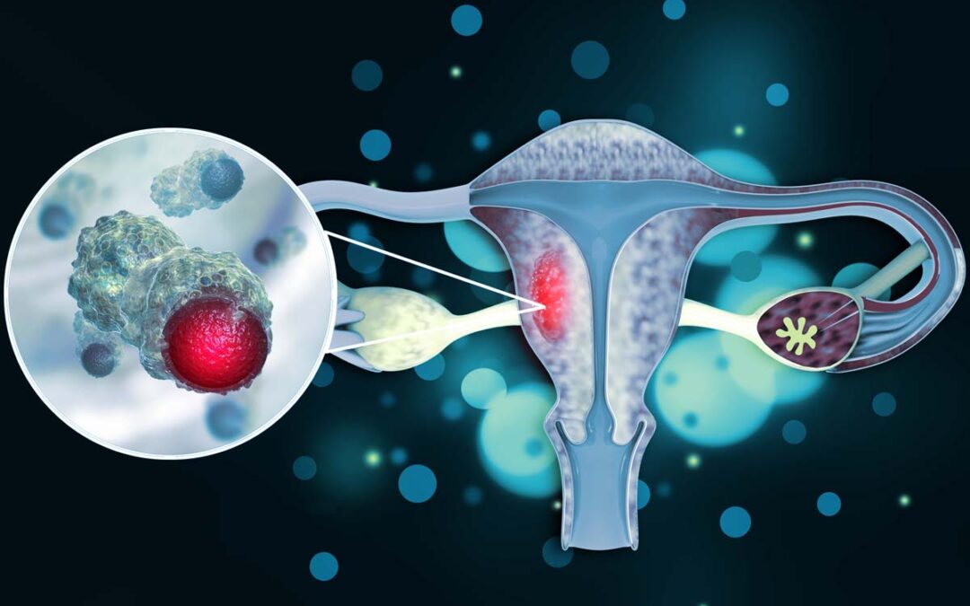 Schonendere Behandlungsoption für Gebärmutterhalskrebs