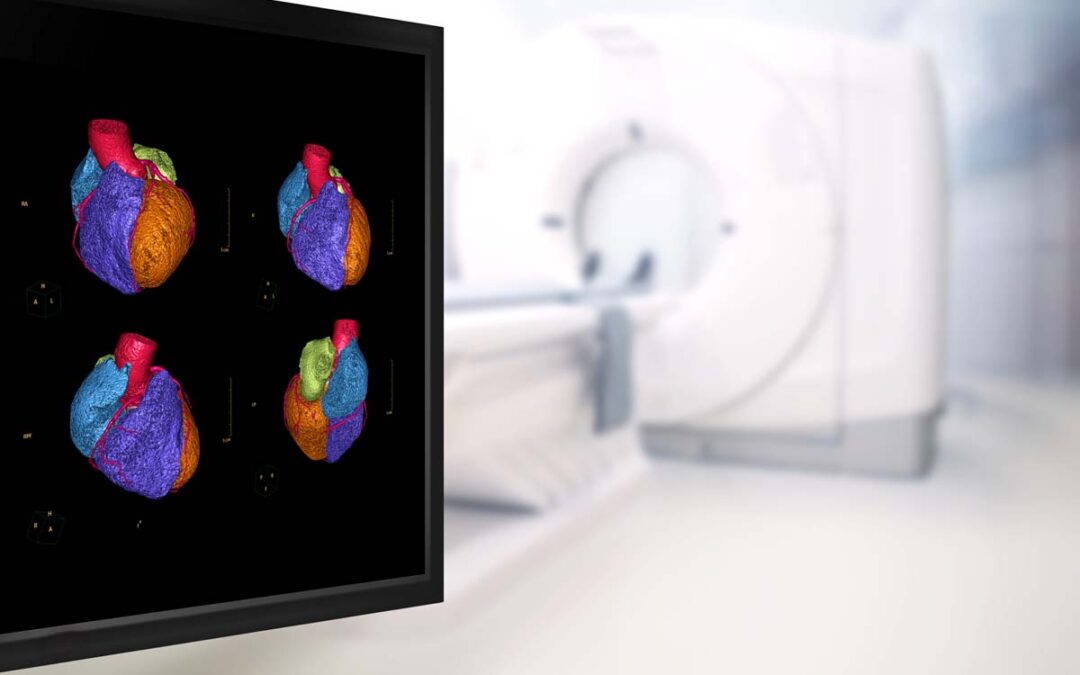 CT-Koronarangiografie zeigt klare Vorteile gegenüber anderen Verfahren