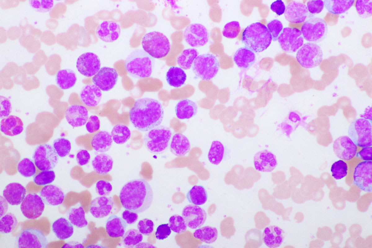 Zellen Chronisch-myeloischer Leukämie