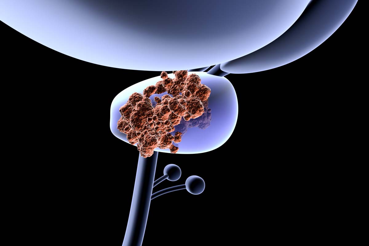 Abbildung von Tumor in Prostata.