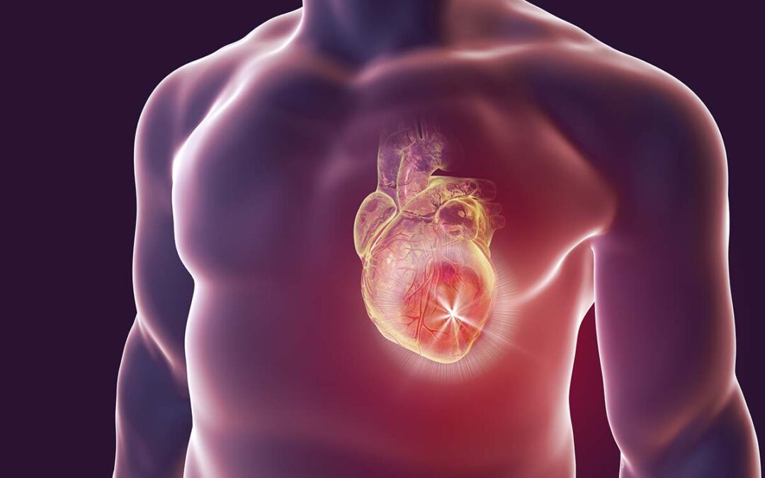 Neue Erkenntnisse zu Troponin-Grenzwerten nach Herz-OPs