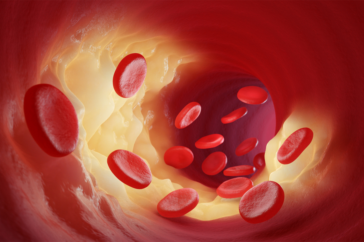 Rote Blutkörperchen gelangen durch die Cholesterin-Plaque in die Arterien oder Venen.