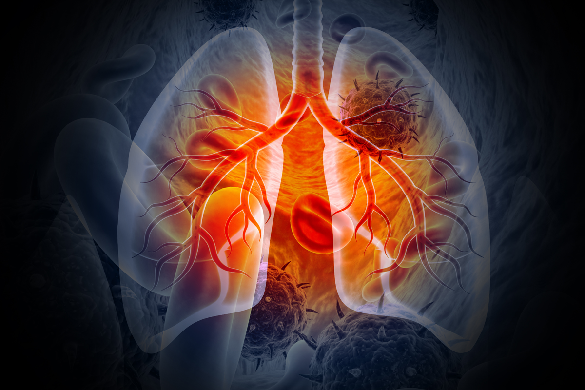 Medizinische Illustration mit Lungenkrebs