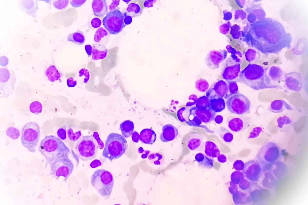Myelomzellen in Knochenmarkausstrich